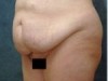 abdominoplastie